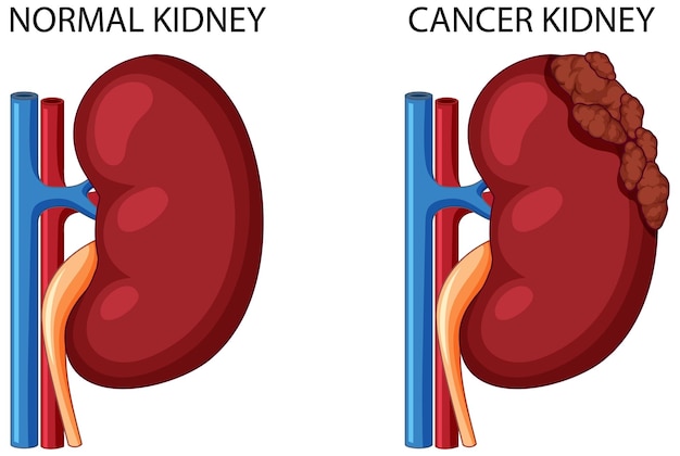 Free Vector normal kidney and cancer kidney