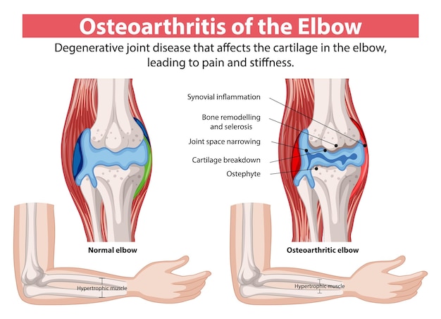 Osteoarthritis of the Elbow