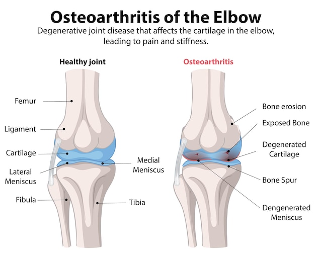 Free vector osteoarthritis of the elbow