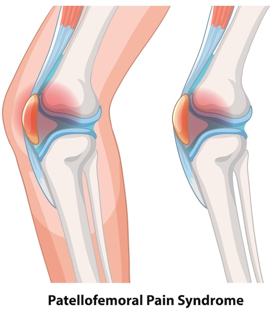 Free vector patellofemoral pain syndrome illustration