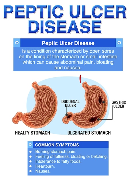 Free Vector peptic ulcer disease explained infographic