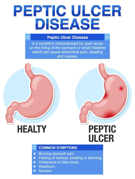 Free Vector peptic ulcer disease explained infographic