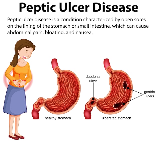 Free Vector peptic ulcer disease infographic