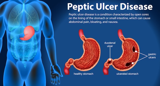 Free Vector peptic ulcer disease infographic