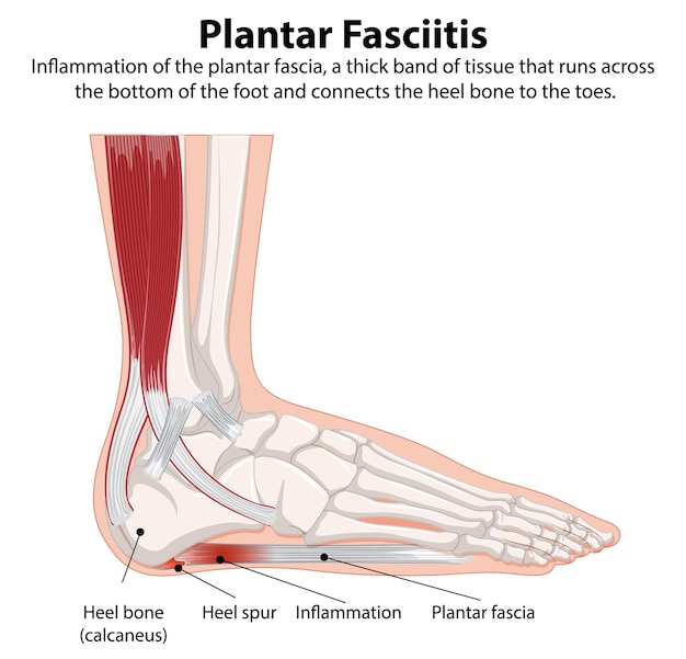 Free vector plantar fasciitis foot anatomy illustration