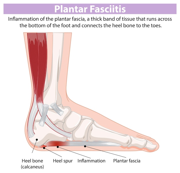 Free vector plantar fasciitis medical illustration