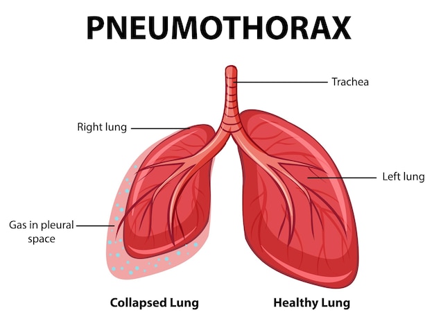 Pneumothorax diagram with collapsed lung and healthy lung