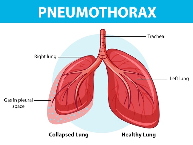 Free Vector pneumothorax diagram with collapsed lung and healthy lung