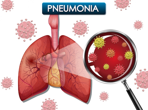 Poster design for pneumonia with human lungs and virus cells