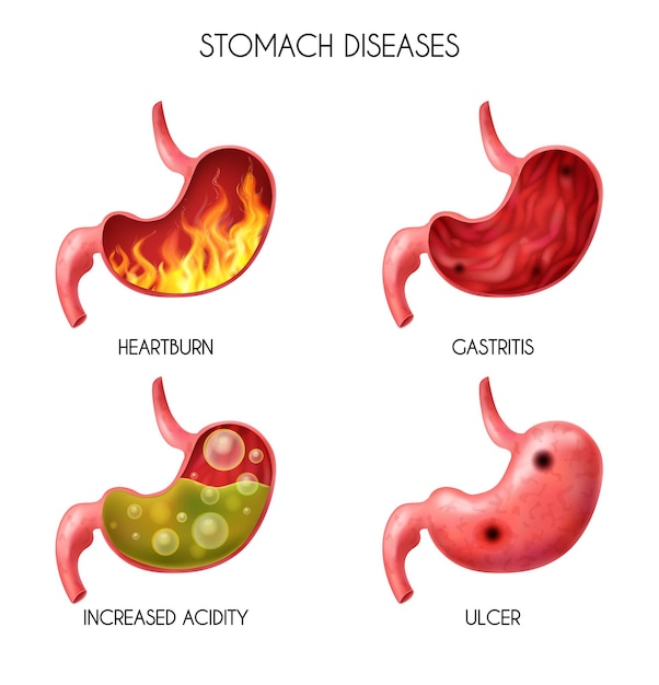 Free Vector realistic human internal organ stomach icon set pyrosis fire disorder gastric acid reflux abdominal bloated ball nausea  illustration