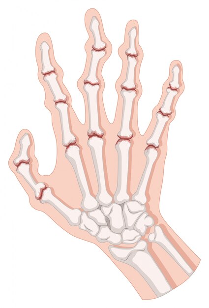 Rheumatoid arthritis in human hand