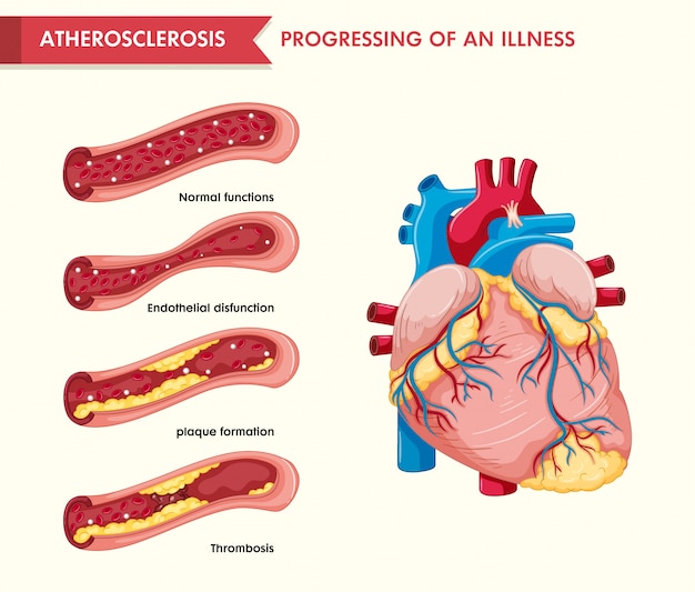 Free Vector scientific medical illustration of atherosclerosis