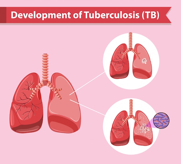 Scientific medical infographic of tuberculosis