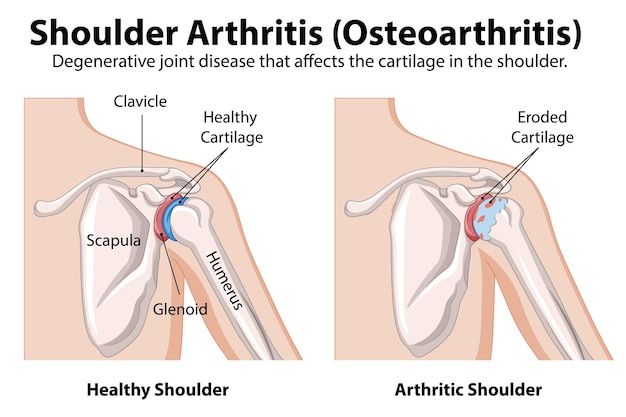 Shoulder Arthritis Comparison Illustration