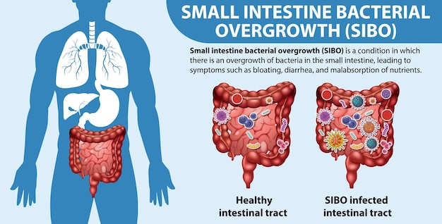 Small Intestine Bacterial Overgrowth SIBO