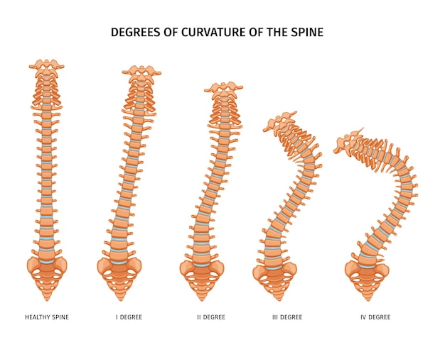 Free Vector spine structure anatomy set of isolated icons showing various degrees of spine curvature healthy and ill vector illustration