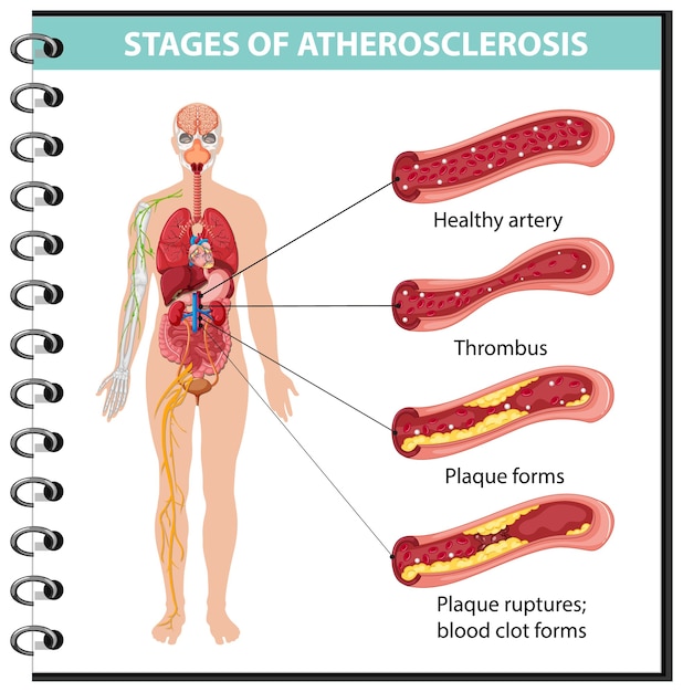 Free Vector stages of atherosclerosis information infographic