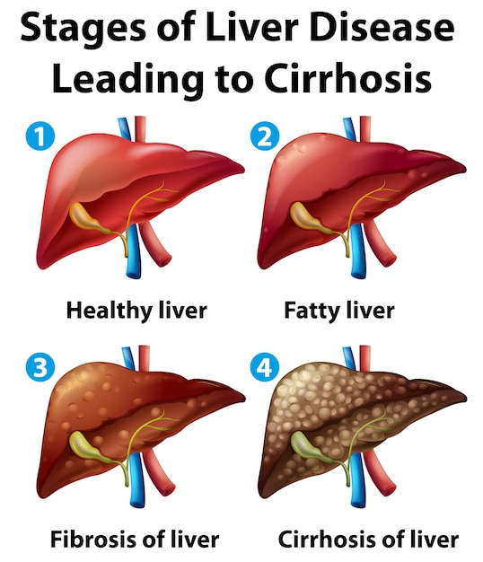 Free vector stages of liver disease leading to cirrhosis