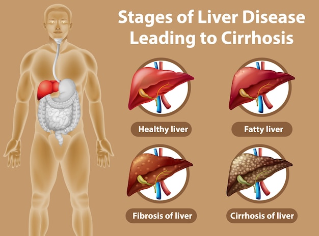 Free vector stages of liver disease leading to cirrhosis