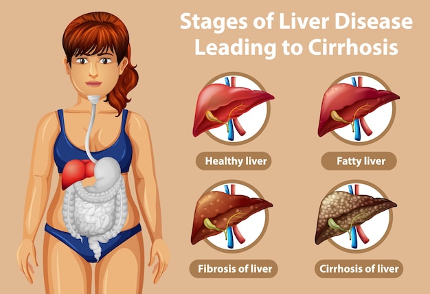 Free vector stages of liver disease leading to cirrhosis