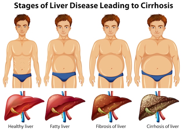 Free vector stages of liver disease leading to cirrhosis