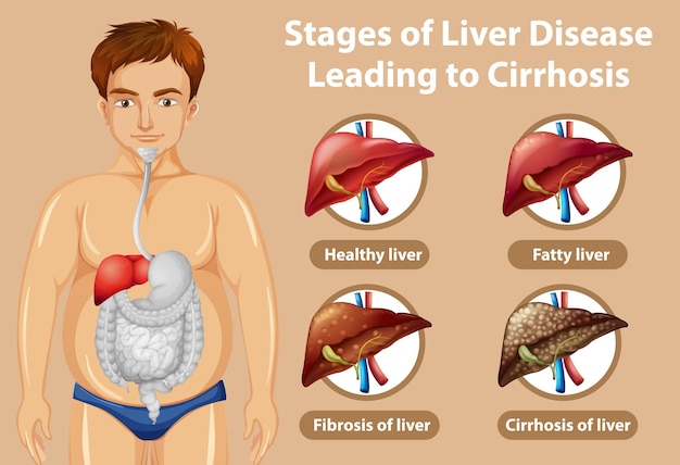 Free vector stages of liver disease leading to cirrhosis