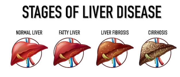 Free vector stages of liver disease