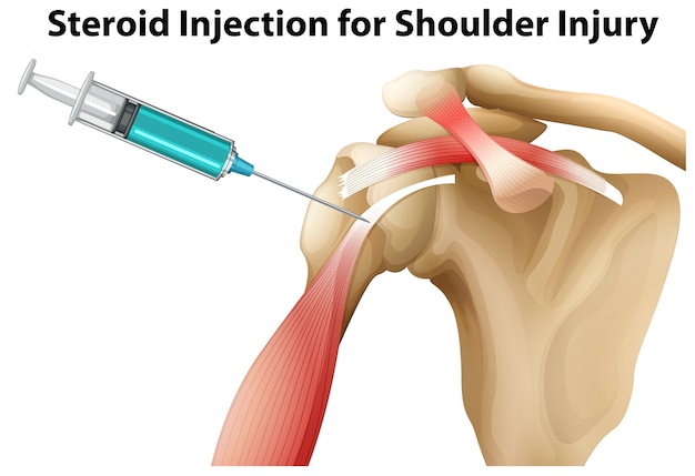 Free Vector steroid injection for shoulder injury