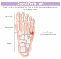 Free vector stress fractures in foot anatomy