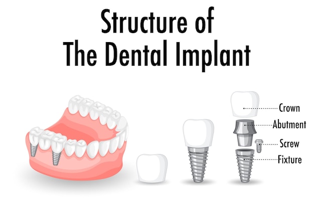 Structure of the dental implant on white background