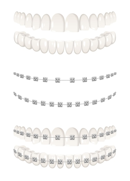 Teeth dental braces realistic icons set isolated vector illustration