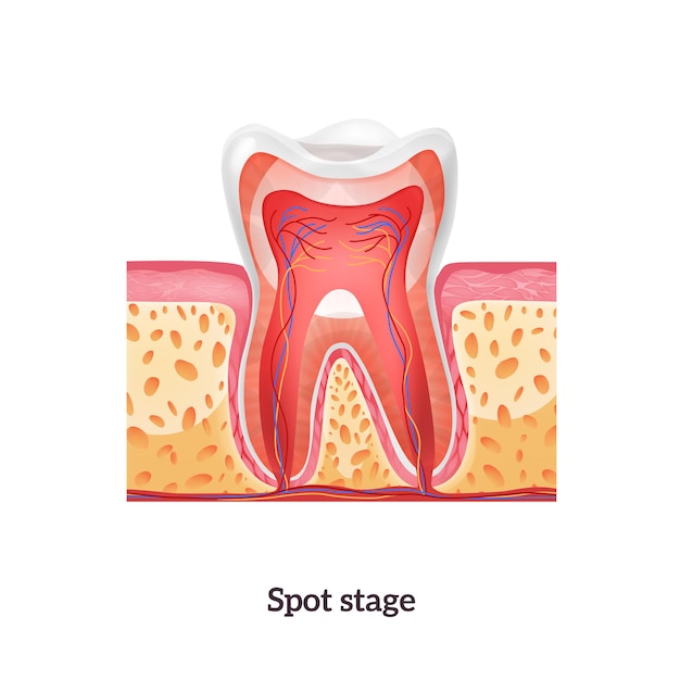 Free vector tooth anatomy with spot stage of caries