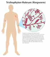 Free vector trichophyton rubrum fungal infection