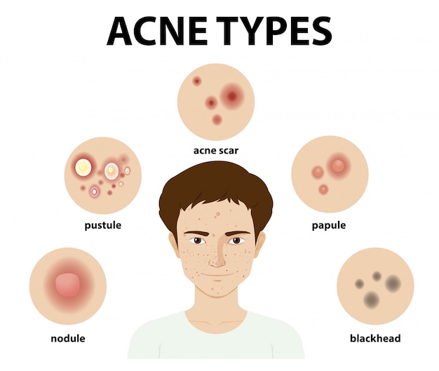 Free Vector types of acne on the skin or pimples