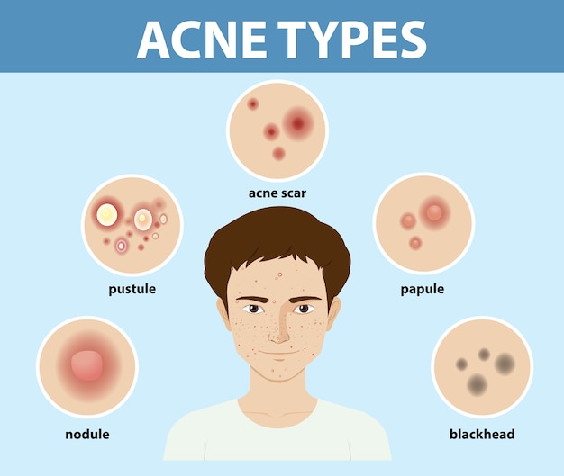 Free Vector types of acne on the skin or pimples