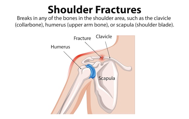 Free vector understanding shoulder fractures