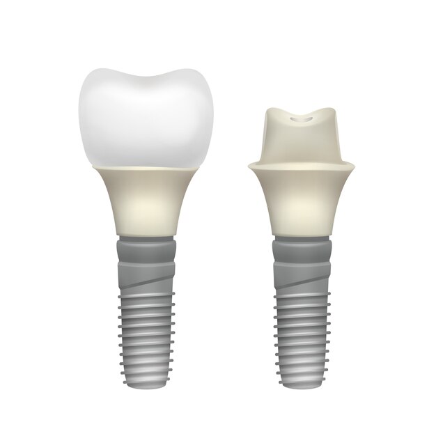 Vector plastic assembled tooth implant side view isolated on white background