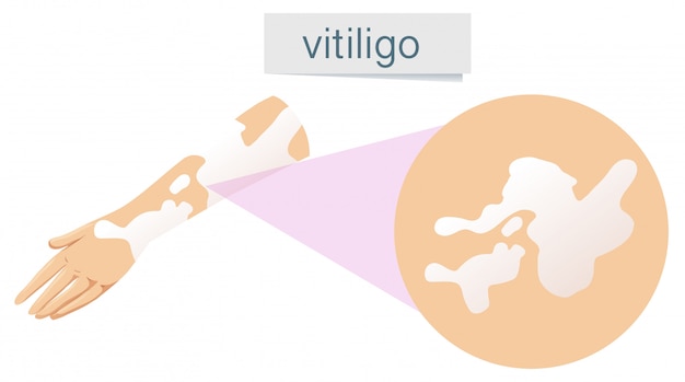 A Vector of Vitiligo on Skin