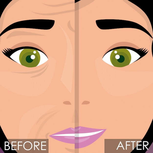 Woman before and after skin treatment