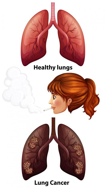 Women smoking with healthy and cancer lungs