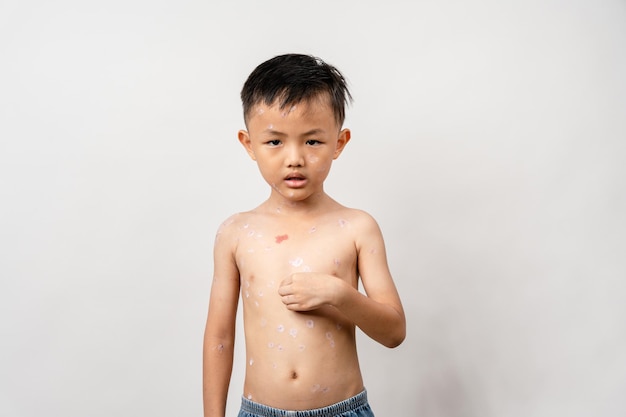 A 7 year old Asian boy has chickenpox pimples on the body of child with chickenpox