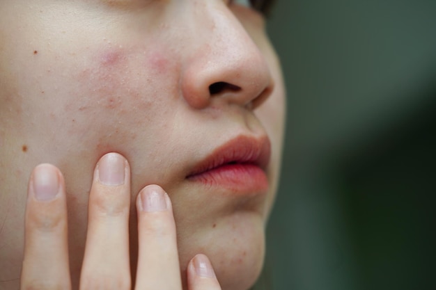 Acne pimple and scar on skin face disorders of sebaceous glands teenage girl skincare beauty problem