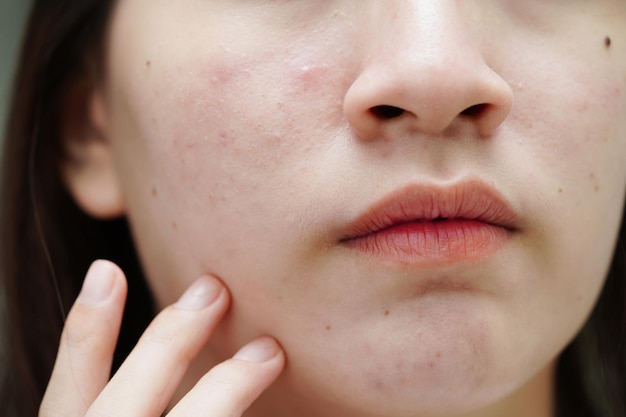 Acne pimple and scar on skin face disorders of sebaceous glands teenage girl skincare beauty problem