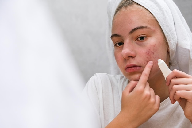 Acne. A teenage girl applying acne medication on her face in front of a mirror. Care for problem skin