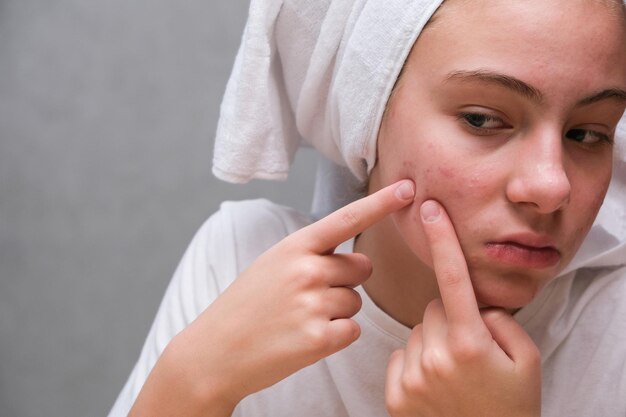 Photo acne a teenage girl squeezing out a pimples on her face in front of a mirror problematic skin