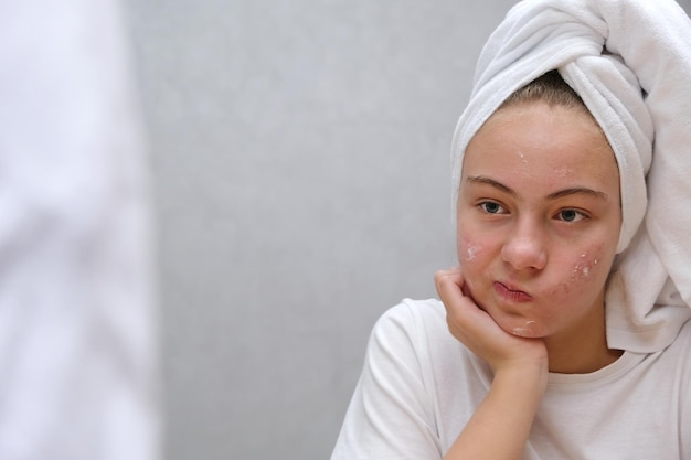 Photo acne. a teenage girl twisted her face, which she does not like because of acne. problematic teenage skin. care for problem skin. acne remedy.