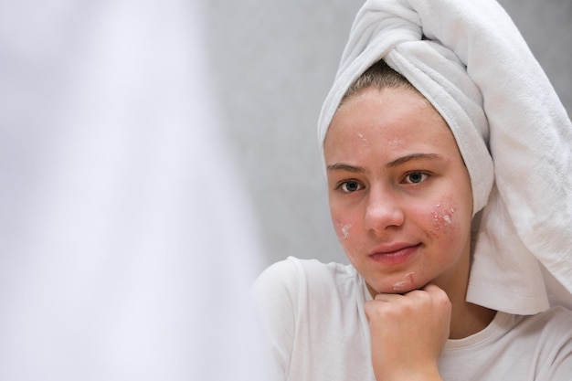 Photo acne. a teenage girl twisted her face, which she does not like because of acne. problematic teenage skin. care for problem skin. acne remedy.