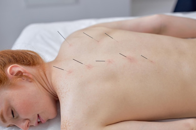 Acupuncture on back spine shoulders for woman client female undergoing acupuncture