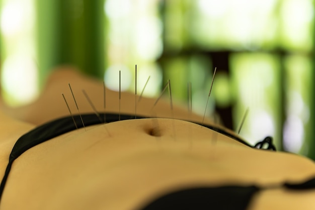 Photo acupuncture needle therapy traditional chinese medicine oriental folk therapy