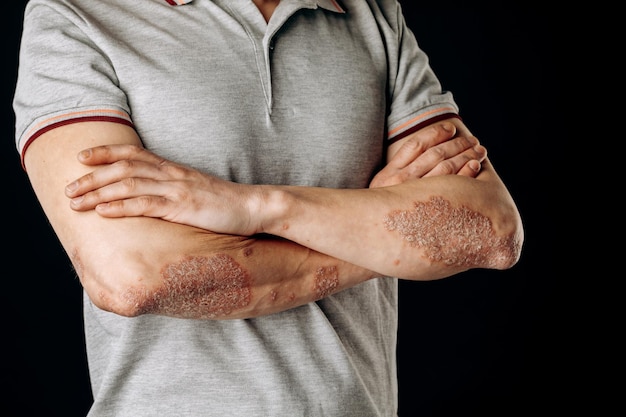 Photo acute psoriasis on the elbows is an autoimmune incurable dermatological skin disease a large red inflamed flaky rash on the elbows joints affected by psoriatic arthritis